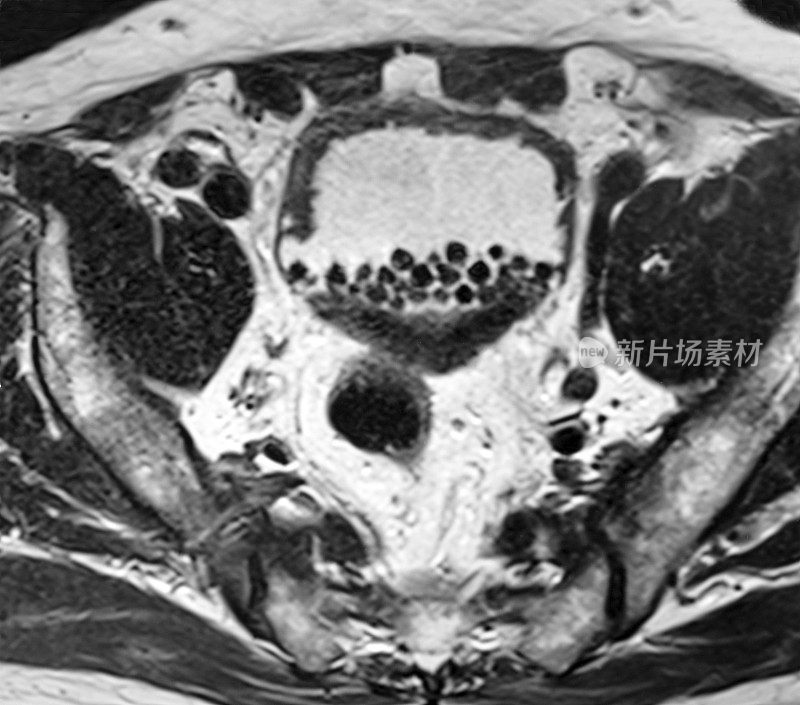 膀胱结石MRI T2体重图像